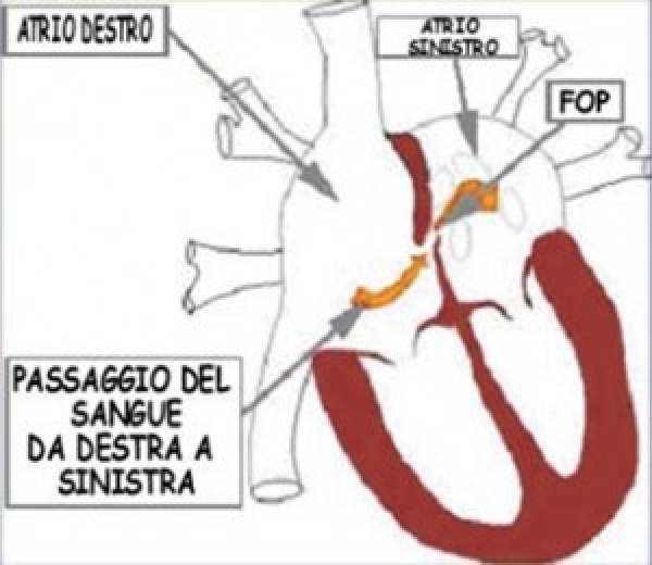 Forame Ovale Pervio (FOP)