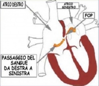 Forame Ovale Pervio (FOP)